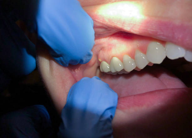 Best Emergency Dental Care for Sports Injuries in West Jefferson, NC